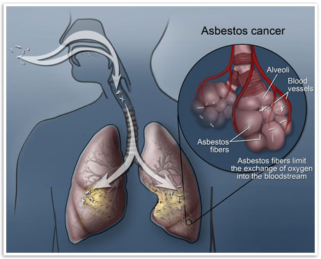 what types of cancer can asbestos cause